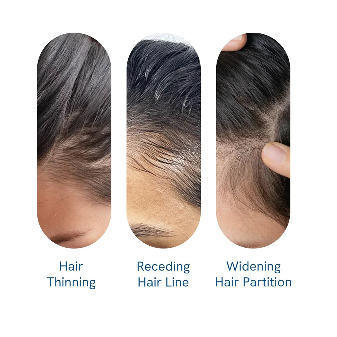 Be Bodywise Advanced Hair Growth Roll-On Serum | 3% Rosemary | 2% Aminexil | 3% Redensy l 2% Anagain | Precision Scalp Applicator | Paraben & Sulphate Free | Non oily and mess free-HHW